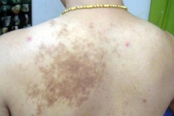 眼睛上的胎记算命分析 眼睛上的胎记算命分析