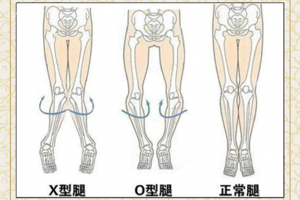 内八字、外八字孩子脚型正常不正常，家长可以这么判断