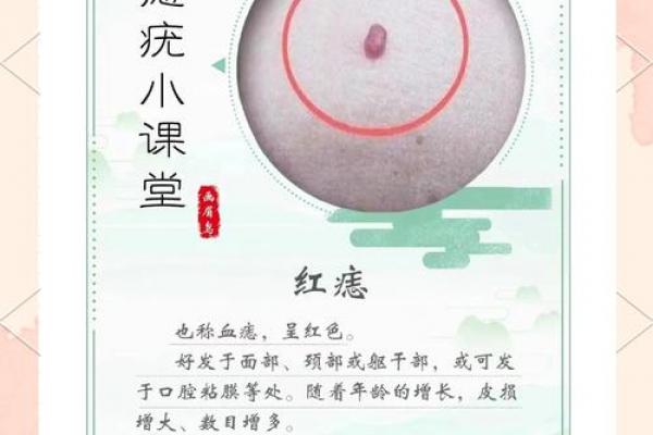 胎记算命图解：什么是红胎记？