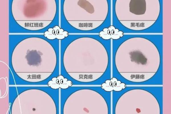 胎记算命图解：什么是红胎记？
