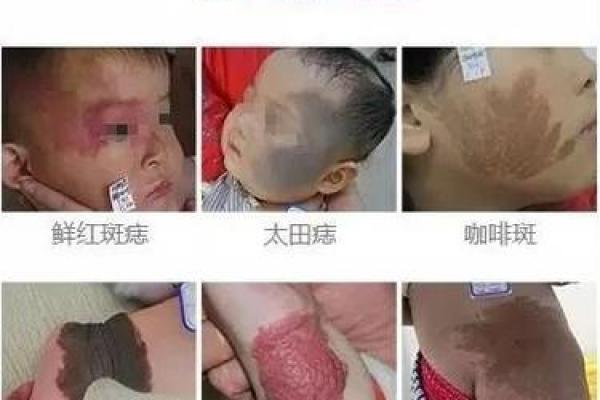 胎记的位置与算命图解